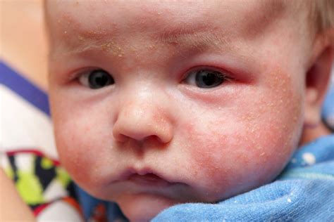 Skin Rashes In Babies Nhs Uk
