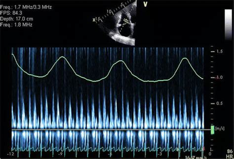 Pulsed Wave Doppler Interrogation Of The Tricuspid Inflow Revealing