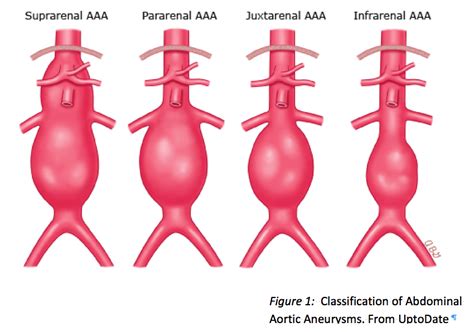 Abdominal Aortic Aneurysm Clinical Highlightsupdates Emdocs