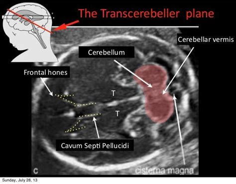 Image Result For Cerebellar Vermis Ultrasound Medical Ultrasound