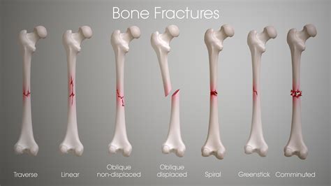 Fractures Types Symptoms Causes And Treatment Scientific Animations