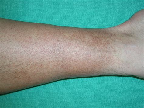 3 Ways To Get Rid Of Skin Discoloration On Your Feet Heidi Salon