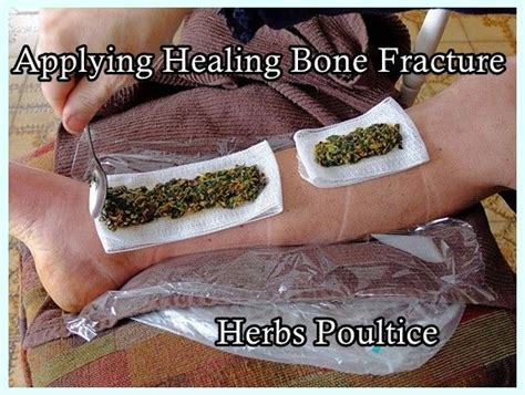 These Steps To Applying A Healing Bone Fracture Herbs Poultice Is A Rapid Bone Healer That