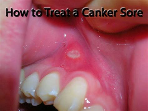 How To Treat Mouth Sores Hubpages