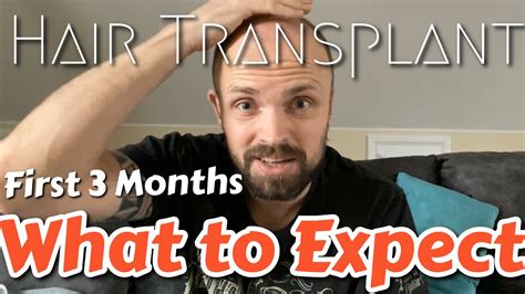 What To Expect In The First Months After A Hair Transplant Youtube