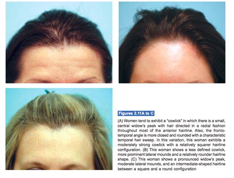 Examples Of Female Hairline Variations Hairtx Drsamlam Hairdisorders