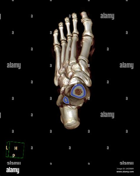 El Pie Humano Color 3d Tomografía Axial Computada Tac De Los Huesos