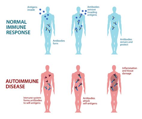 Autoimmune Elimination Program Autoimmune Disease Autoimmune Reduce