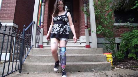 Amputeeot Walking On A Prosthetic Leg 25 Months After Amputation