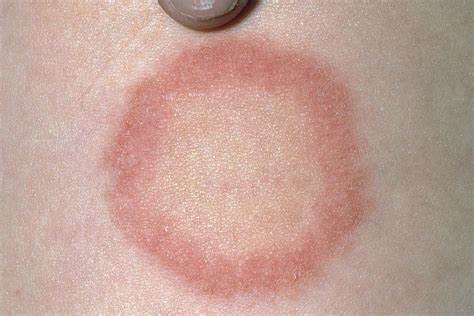 What Does Ringworm Look Like Nhs Health Tips Hot Sex Picture
