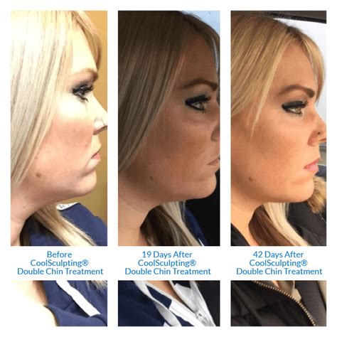 List 97 Pictures Coolsculpting Neck Before And After Pictures Full Hd
