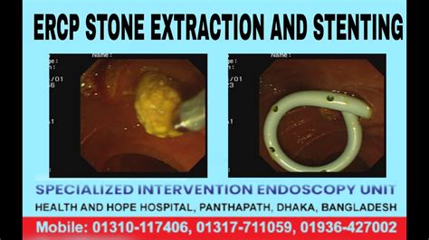 ERCP STONE EXTRACTION AND STENTING DR MASFIQUE AHMED BHUIYAN FCPS BEST