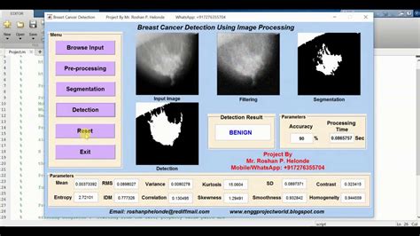 Breast Cancer Detection Using Machine Learning Matlab Source Code Youtube