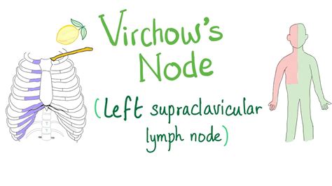 Supraclavicular Lymph Nodes Diagram