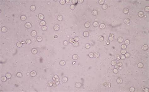 White Blood Cells In Urine Cancer