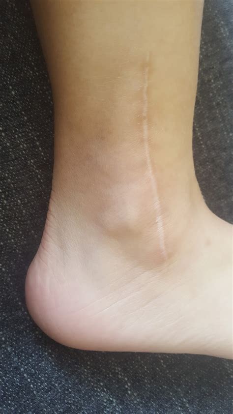 My Broken Ankle 4 Years 5 Months Surgery Scar