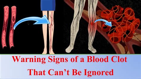 Warning Signs Of A Blood Clot That Cant Be Ignored Youtube