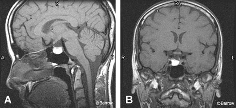 Imaging Of The Pituitary Gland Barrow