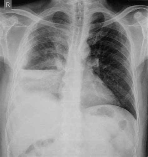 Chest X Ray Showing Right Hydro Pneumothorax Download Scientific