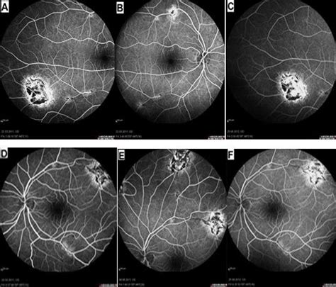 Fundus Fluorescein Angiography Of The Right A B And C As Well