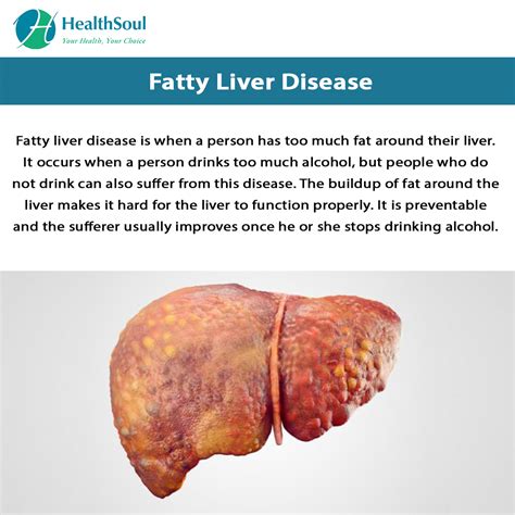 Fatty Liver Disease Causes And Treatment Healthsoul
