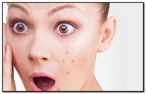 What Causes Acne On The Face Chest And Back Skin Problems