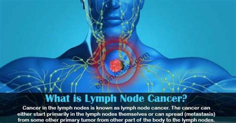 Stage 2 Cancer Lymph Nodes