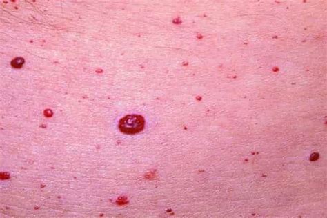 Petechiae Tiny Pinpoint Red Dots On Skin Shoppersilope