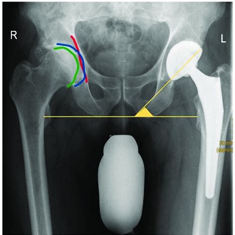 Example Of A Patient With Coxa Profunda Of The Right Hip The Medial
