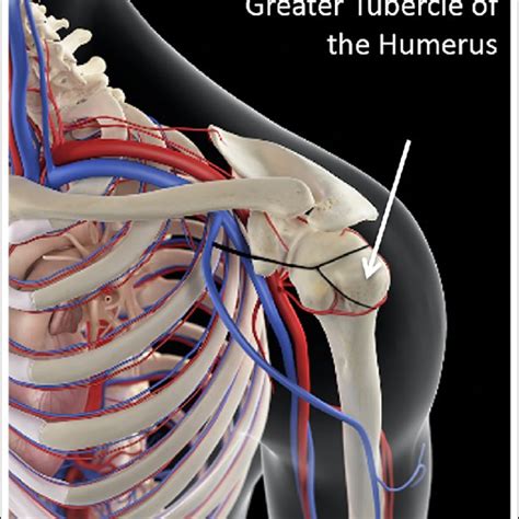 Demonstration Of The Humeral Head Intraosseous Procedure On The Partial