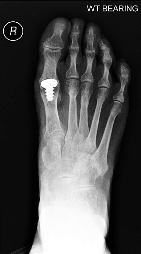 Hemiarthroplasty For Hallux Rigidus Mid Term Results The Journal Of