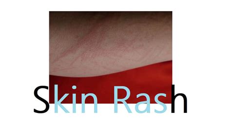 Skin Rash 19 Types Causes Symptoms And Diagnosis 2024