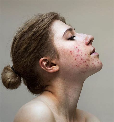 10 Inspiring Images That Prove Acne Is Not Ugly