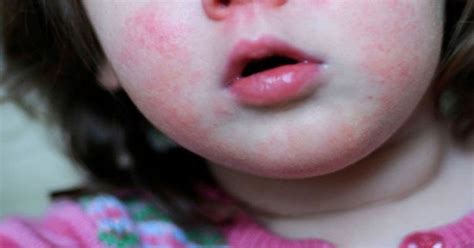 Scarlet Fever Outbreak Shock Rise In Contagious Disease Sweeping Uk
