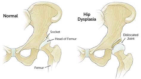 Developmental Dysplasia Of The Hip Causes Symptoms Diagnosis