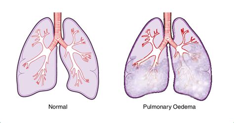 Acute Cardiogenic Pulmonary Oedema Acpo Is A Common Presentation For