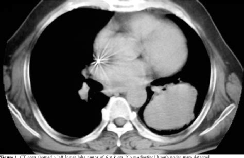 Figure 1 From Poorly Differentiated Primary Monophasic Synovial Sarcoma
