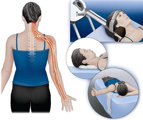 Neck And Arm Pain Mechanical Traction And Exercises Prove An Effective