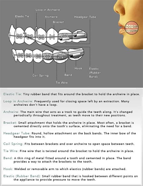 Braces Diagram Mandeville Orthodontics Mandeville Jamaica