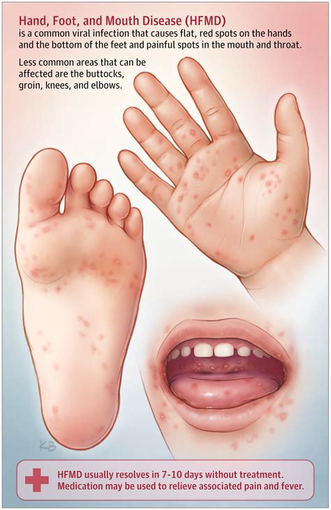 Visit the national agricultural library of the u.s. Hand, Foot, and Mouth Disease | Dermatology | JAMA | JAMA ...