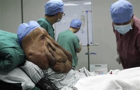 Elephant Man Has A Total Of 19kgs Of Tumour Removed From His Face But It S Still Growing