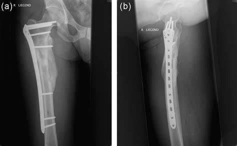 Reversed Liss Df In Selected Cases Of Complex Proximal Femur Fractures