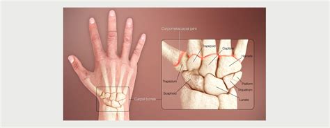 scaphoid fracture motus physical therapy