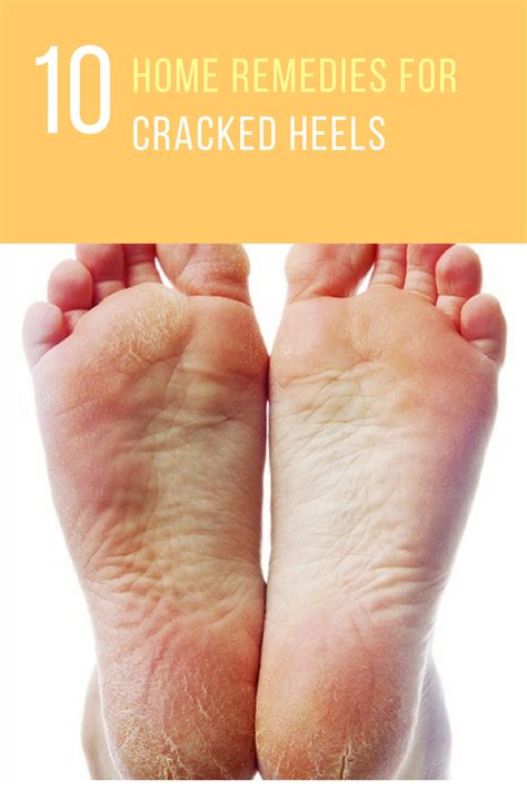 10 Incredible Natural Remedies For Cracked Heels