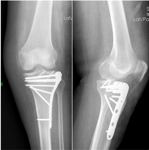 Diagnosis And Treatment Of Schatzker Type Ii Tibial Plateau Fracture