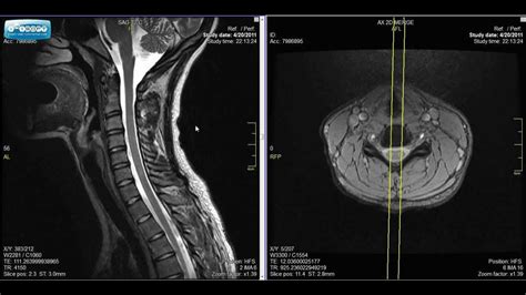 Normal Cervical Spine Mri Explained Dr Jeffrey Pjohnson Hd Youtube