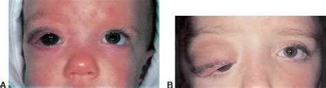 Plexiform Neurofibroma Eyelid