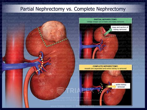 Partial Nephrectomy Vs Complete Nephrectomy Trialexhibits Inc