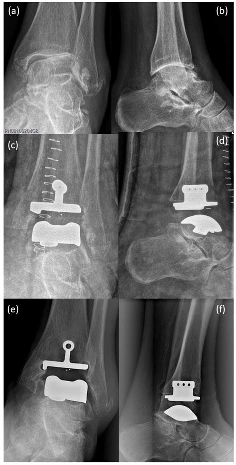 Life Free Full Text Arthrodesis And Defect Bridging Of The Upper