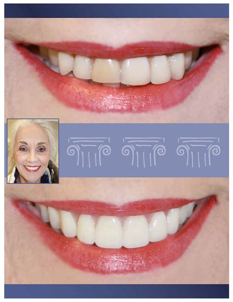 Cosmetic Dentistry Dental Implants Dental Bridges Right Smile